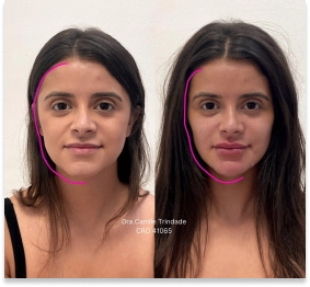 Harmonização Faciel e Contornos