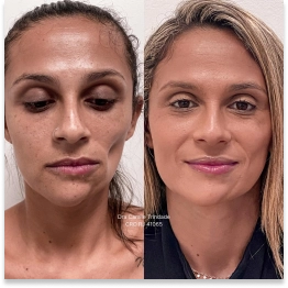 Correção de Assimetrias